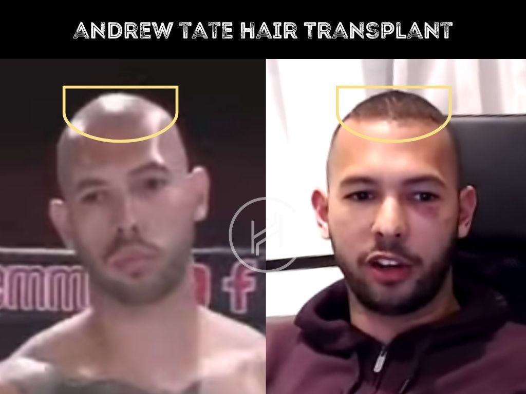 andrew tate hair transplant hairline before after
