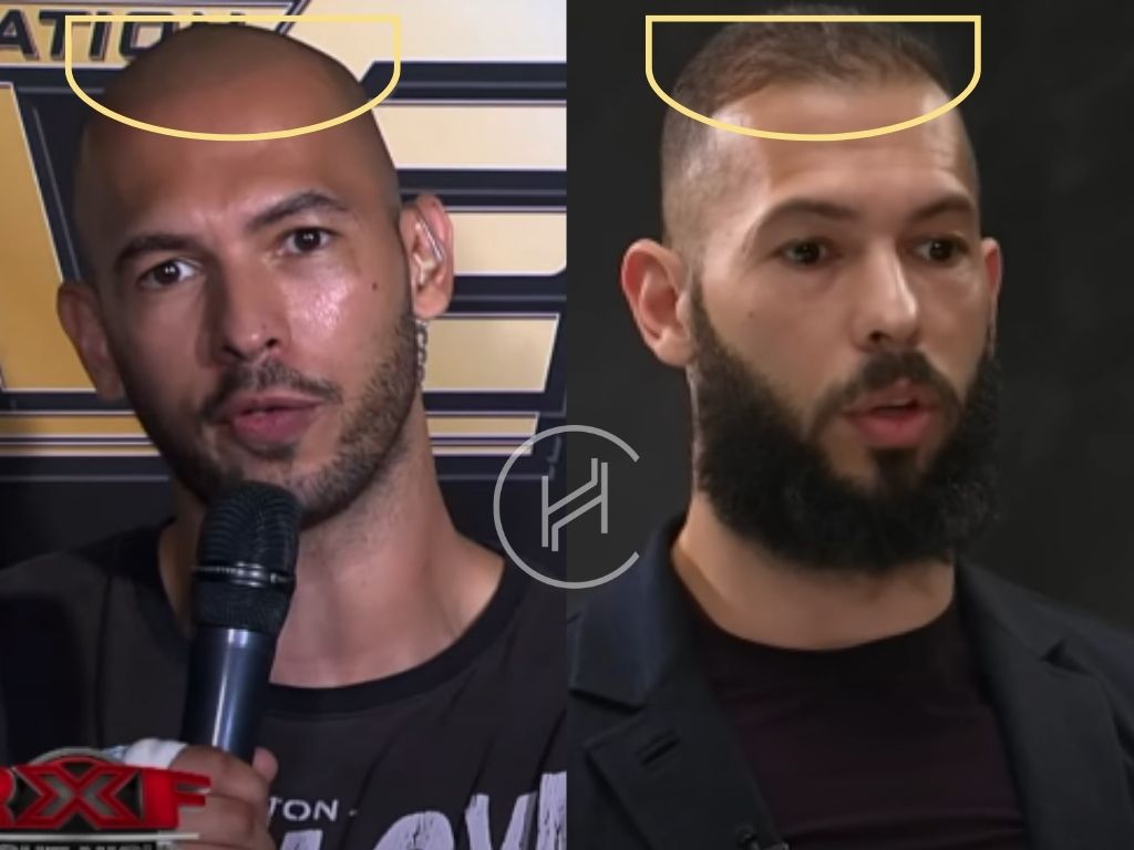 andrew tate hair transplant before and after result