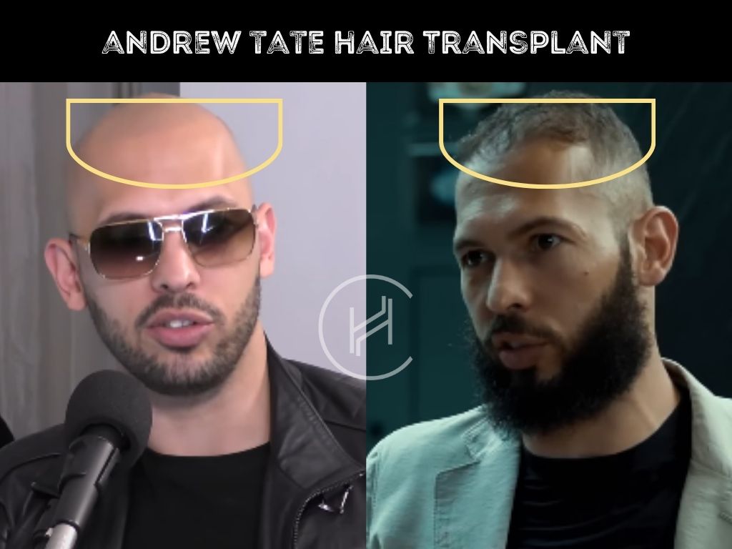 andrew tate - hair transplant before and after