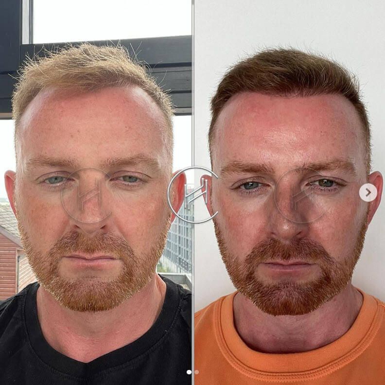 3100 grafts hair transplant before and after result - blonde hair
