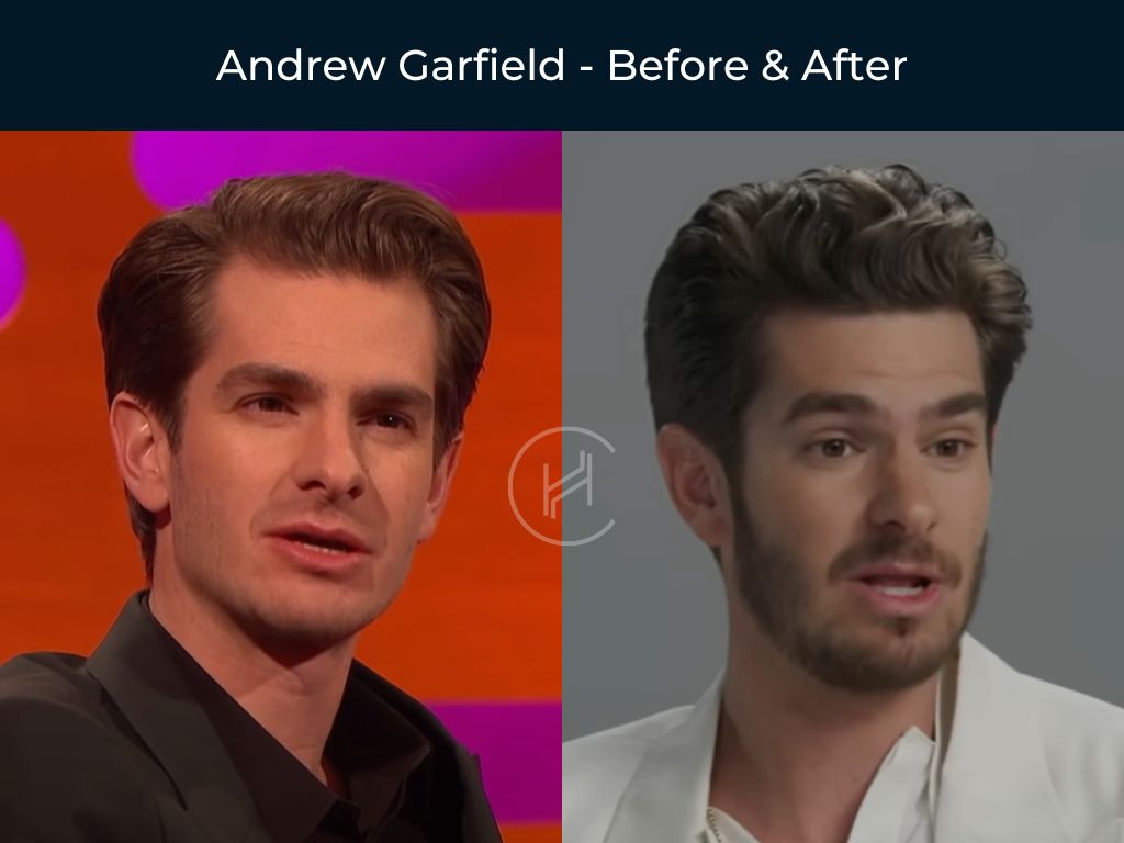 Andrew Garfield - Hair Transplant Before and After