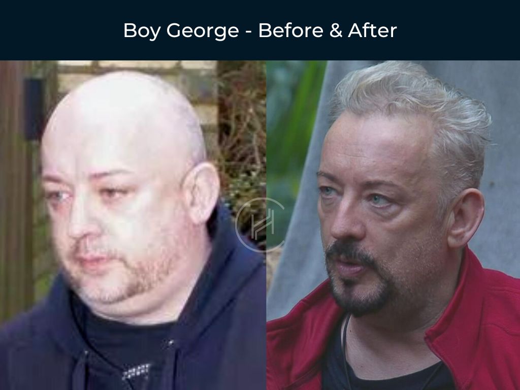 Boy George - Hair Transplant Before and After