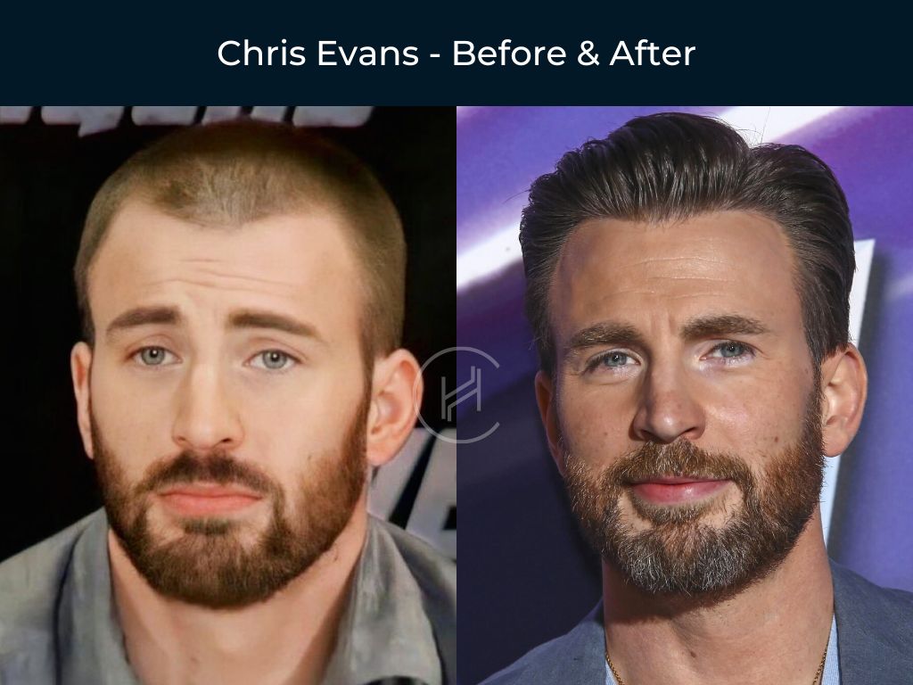 Chris-Evans-Hair-Transplant-Before-and-After Chris Evans - Hair Transplant Before and After