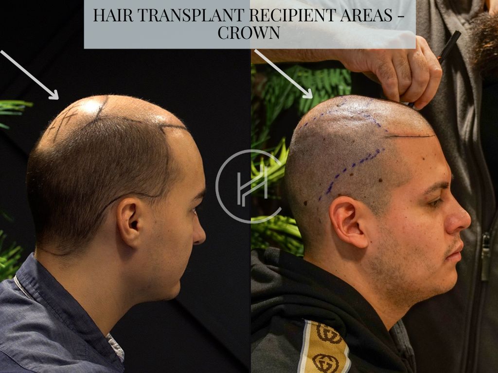 Crown area as a hair transplant recipient area