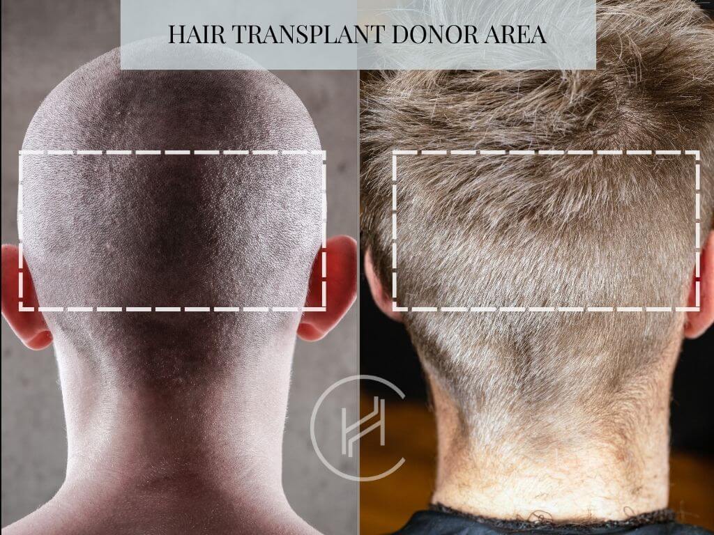 Hair Transplant Donor Area