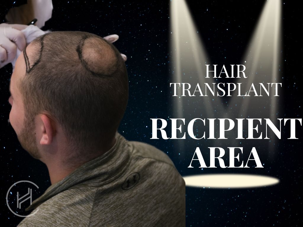 Hair Transplant Recipient Area Banner