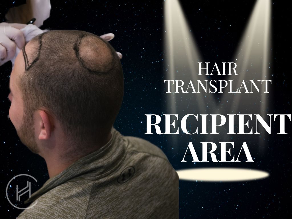 Hair Transplant Recipient Area Banner