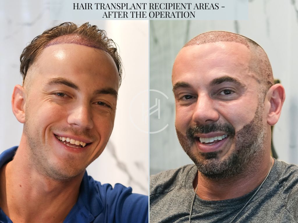 Hair Transplant Recipient Areas - After the Operation