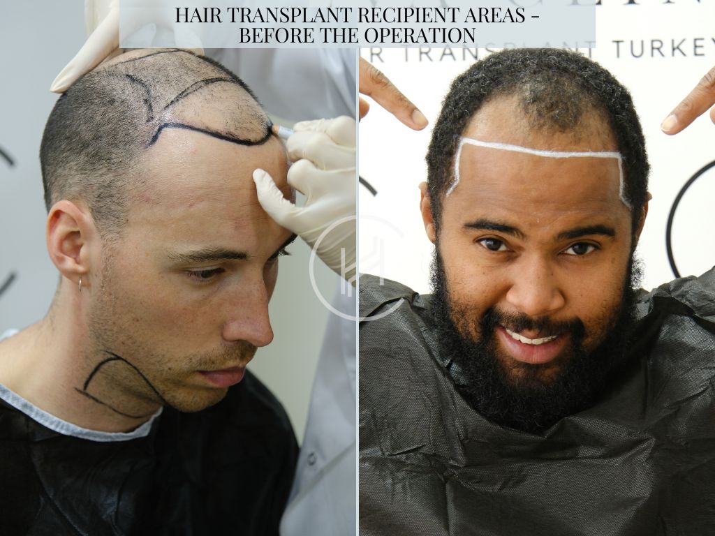 Hair Transplant Recipient Areas - Before the Operation