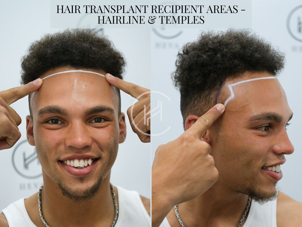 Hair Transplant Recipient Areas - Hairline and Temples