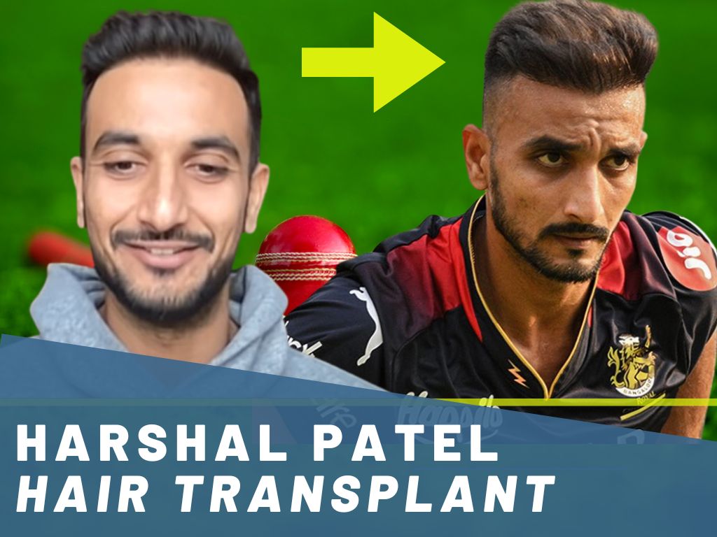 Harshal Patel Hair Transplant Analysis Before & After