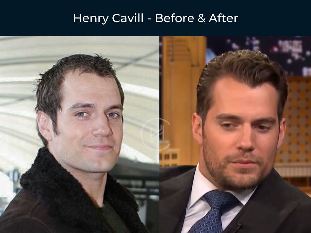 Henry Cavill - Hair Transplant Before and After