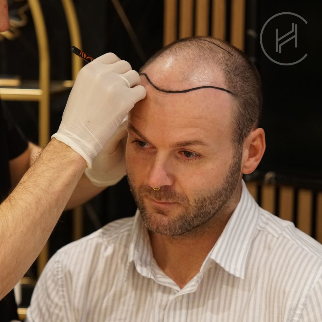 Needle-Free Hair Transplant Male Candidate
