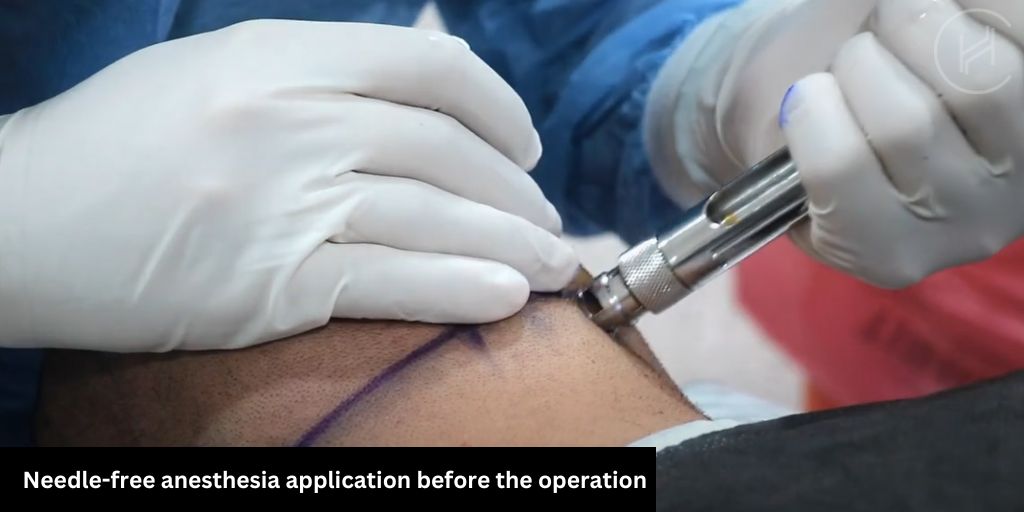 Painless needle free anesthesia application before hair transplant