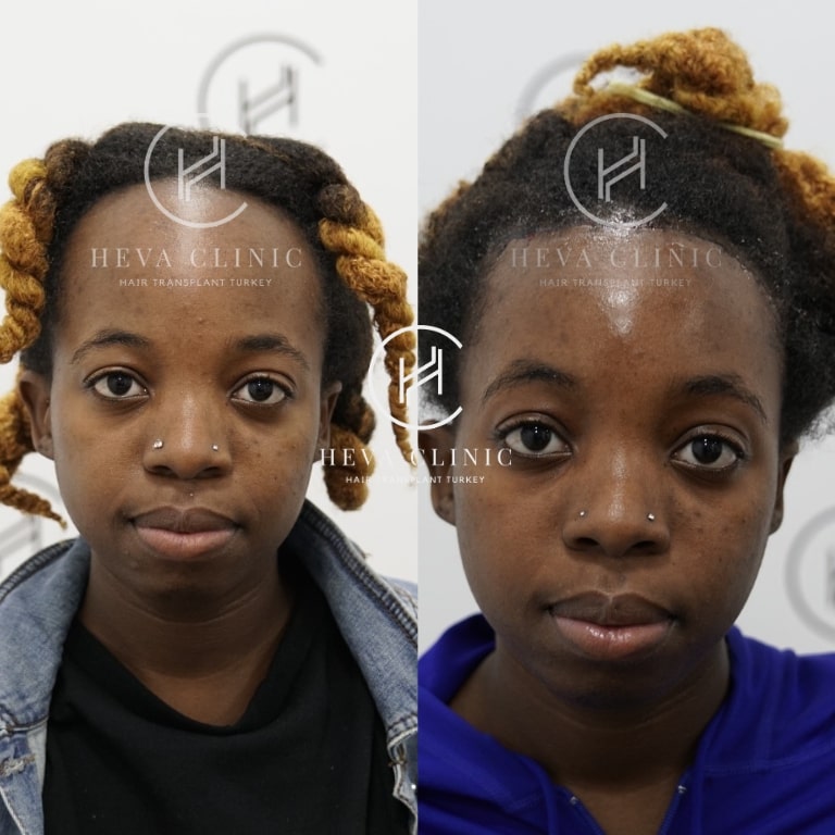 afro female forehead reduction surgery before & after - front