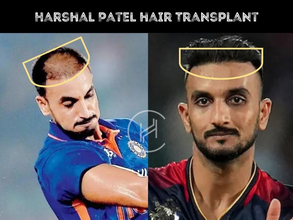 harshal patel hair transplant before & after result