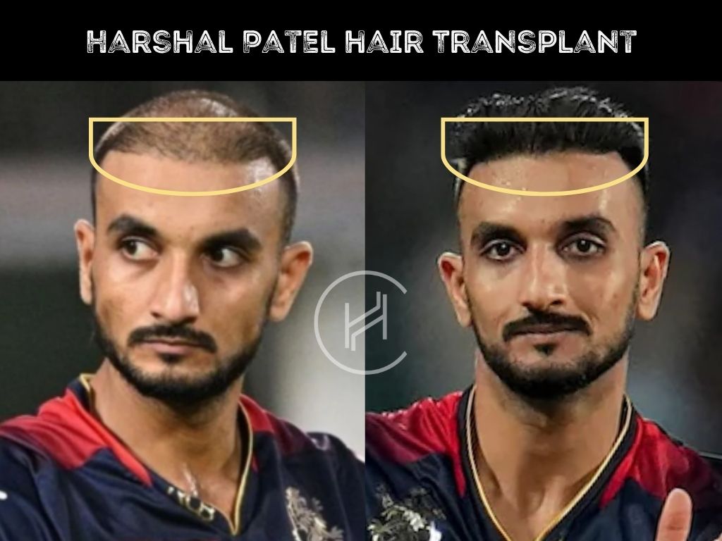 harshal patel hair transplant before after photo