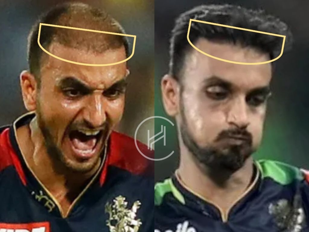harshal patel - hair transplant before and after result