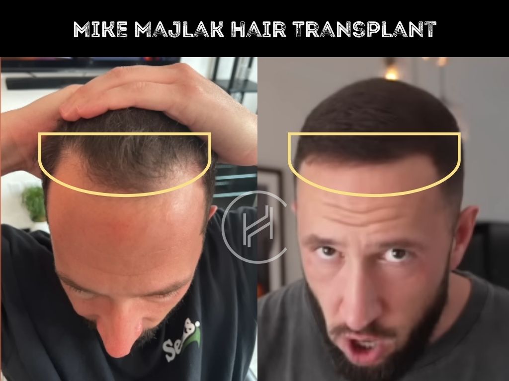 mike majlak hair transplant before after result