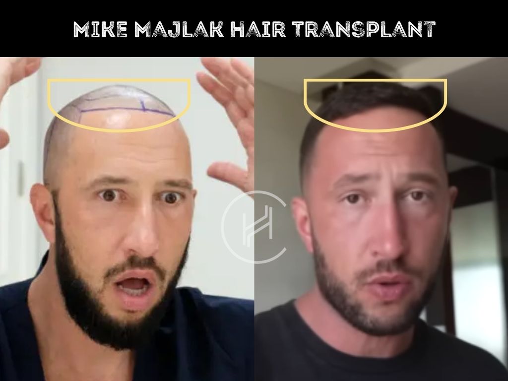 mike majlak hair transplant before & after
