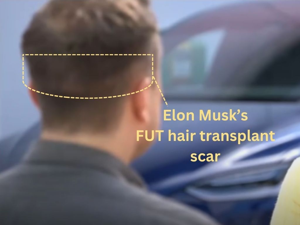 Elon Musk’s FUT hair transplant scar