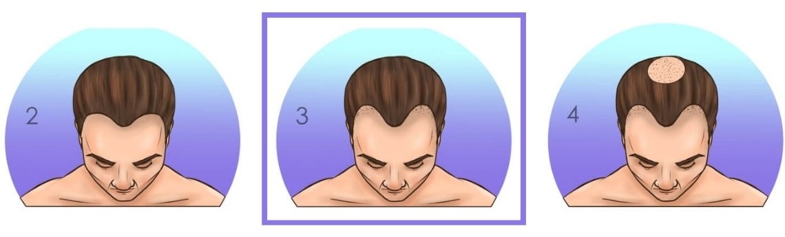 Norwood stage 3 hair loss candidate
