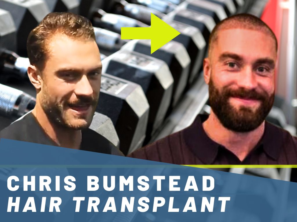 chris bumstead hair transplant analysis banner