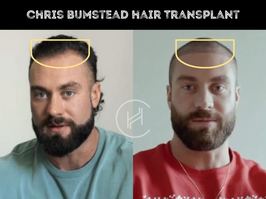 cbum hair transplant before after result