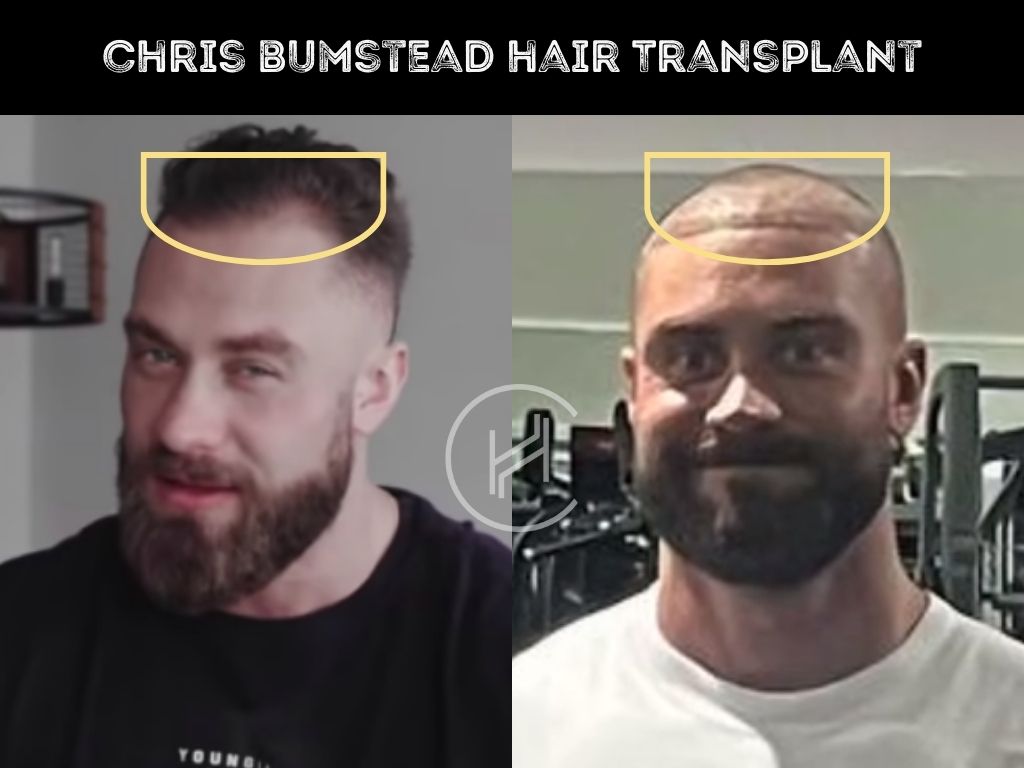 chris bumstead (cbum) hair transplant before after