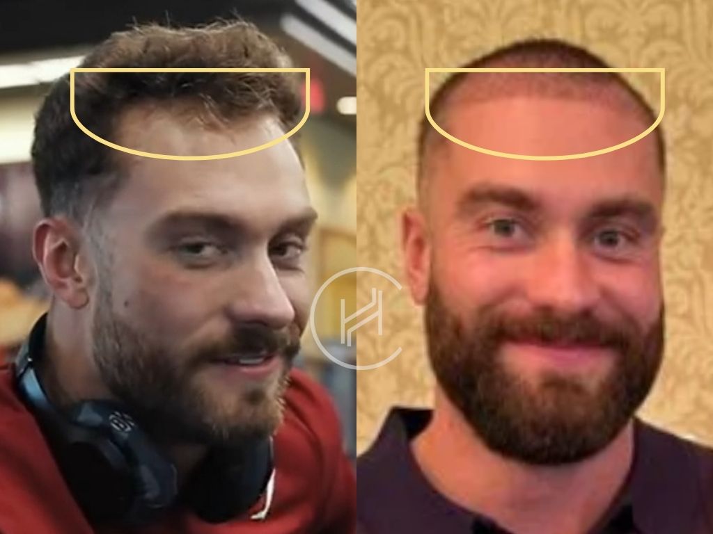 chris bumstead - hair transplant before and after result