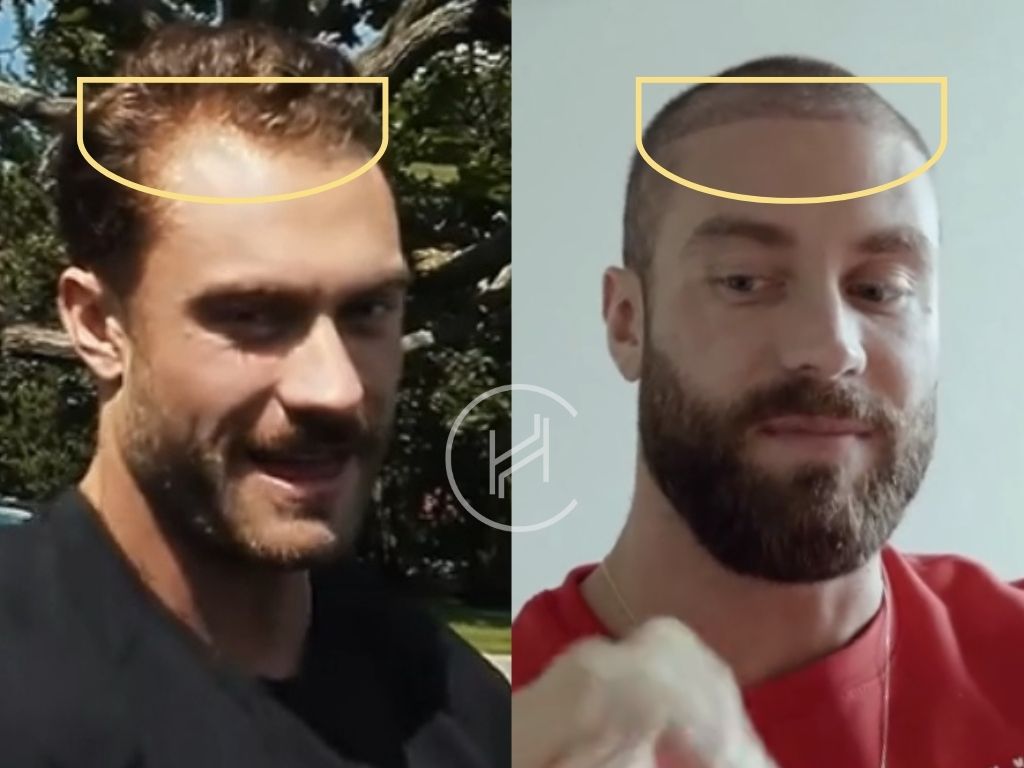 chris bumstead - hair transplant before and after