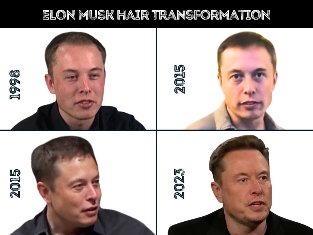 elon musk hair loss transformation photos