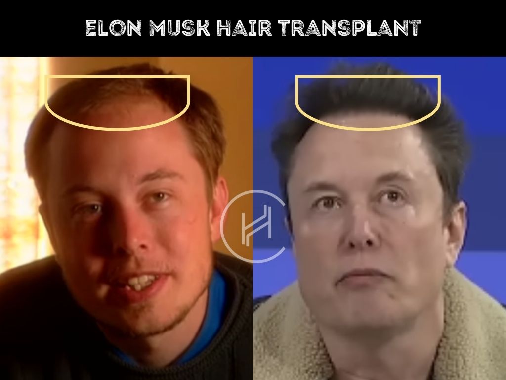 elon musk - hair transplant before after result