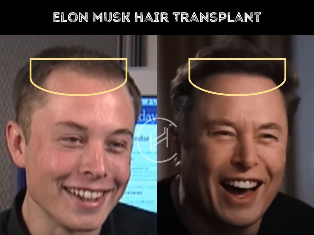 elon musk hair transplant before after