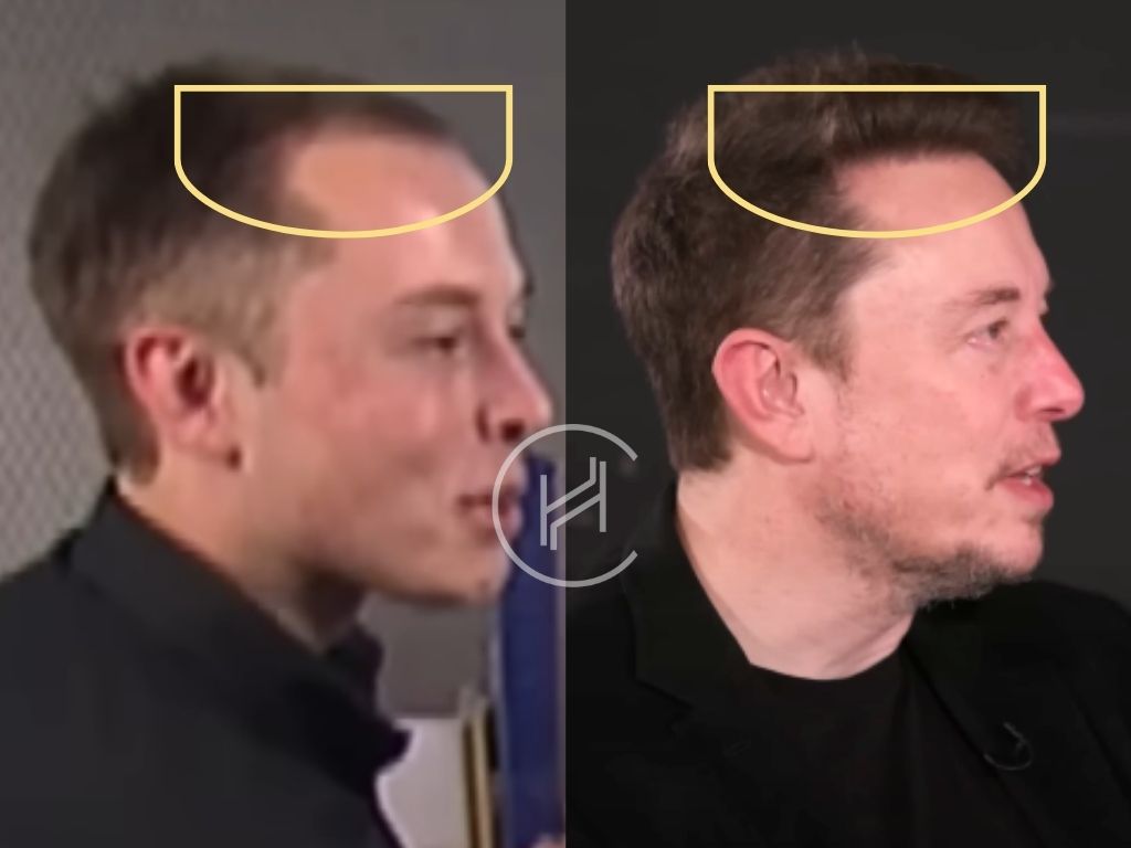 elon musk hair transplant before and after result