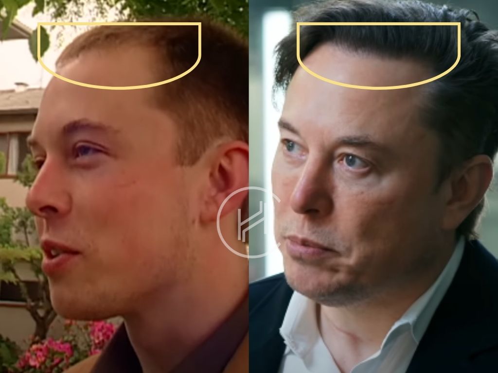 elon musk hair transplant before and after temple area