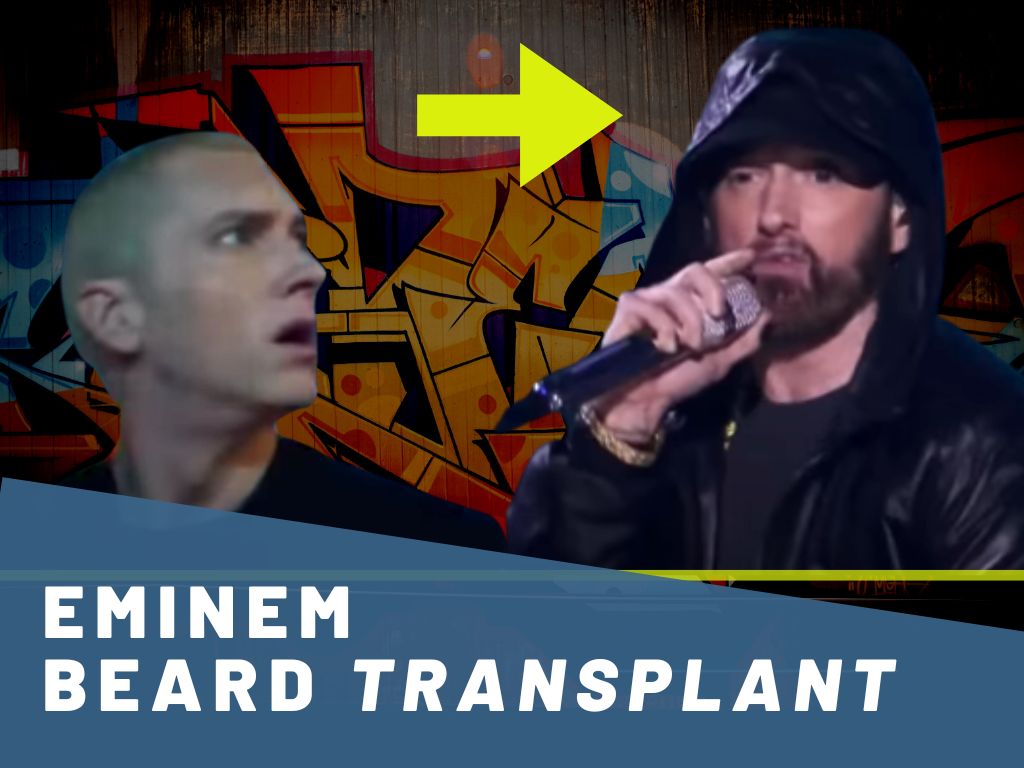 eminem beard transplant analysis banner