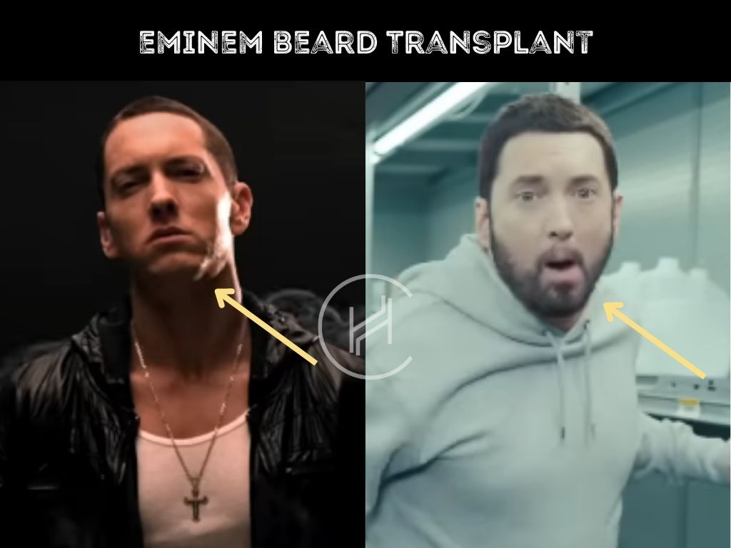eminem beard transplant before after difference