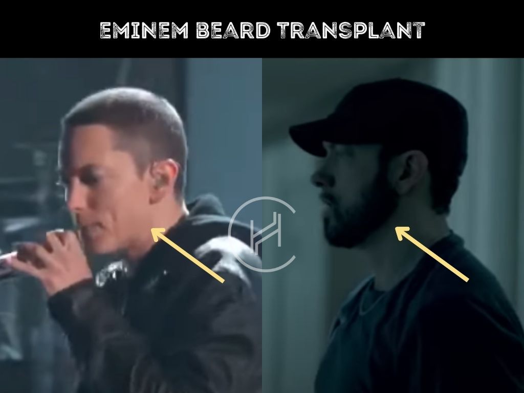 eminem beard transplant before after