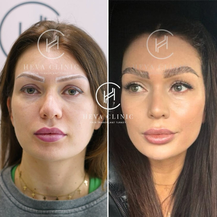 female eyebrow transplant before and after - 350 grafts
