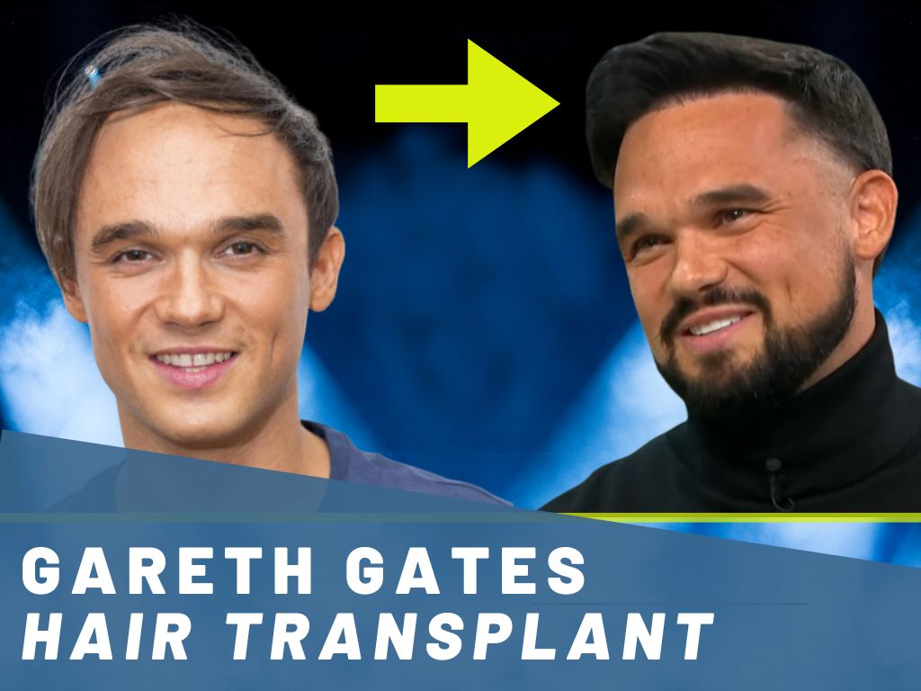 gareth gates hair transplant analysis banner
