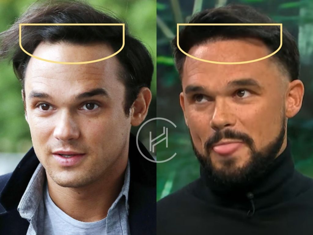 gareth gates hair transplant before after result