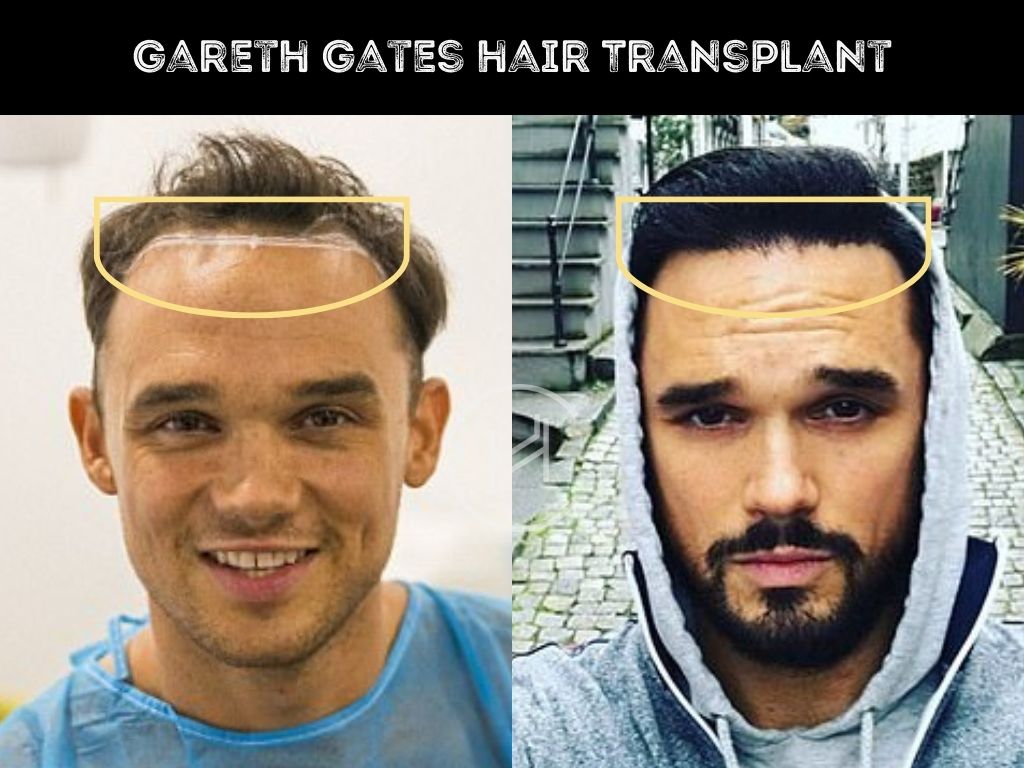 gareth gates hair transplant before and after