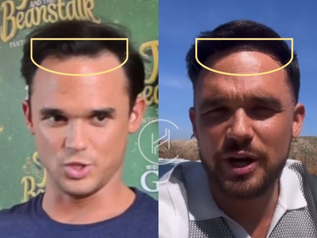 gareth gates - hair transplant before and after result