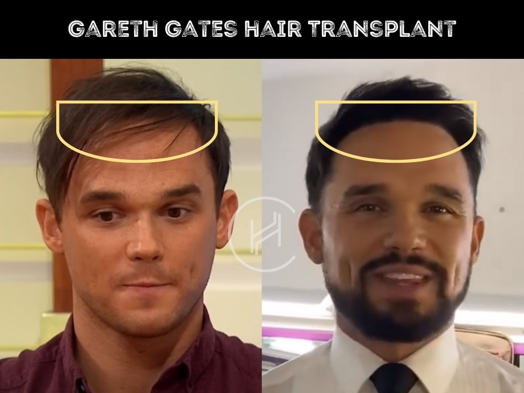 gareth gates - hair transplant before and after photo