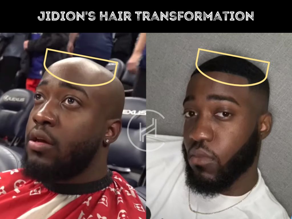 jidion - hair transplant before after result