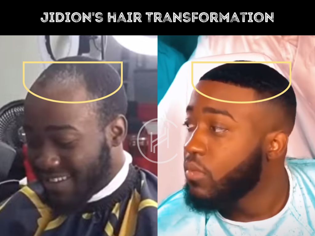 jidion hair transplant before after