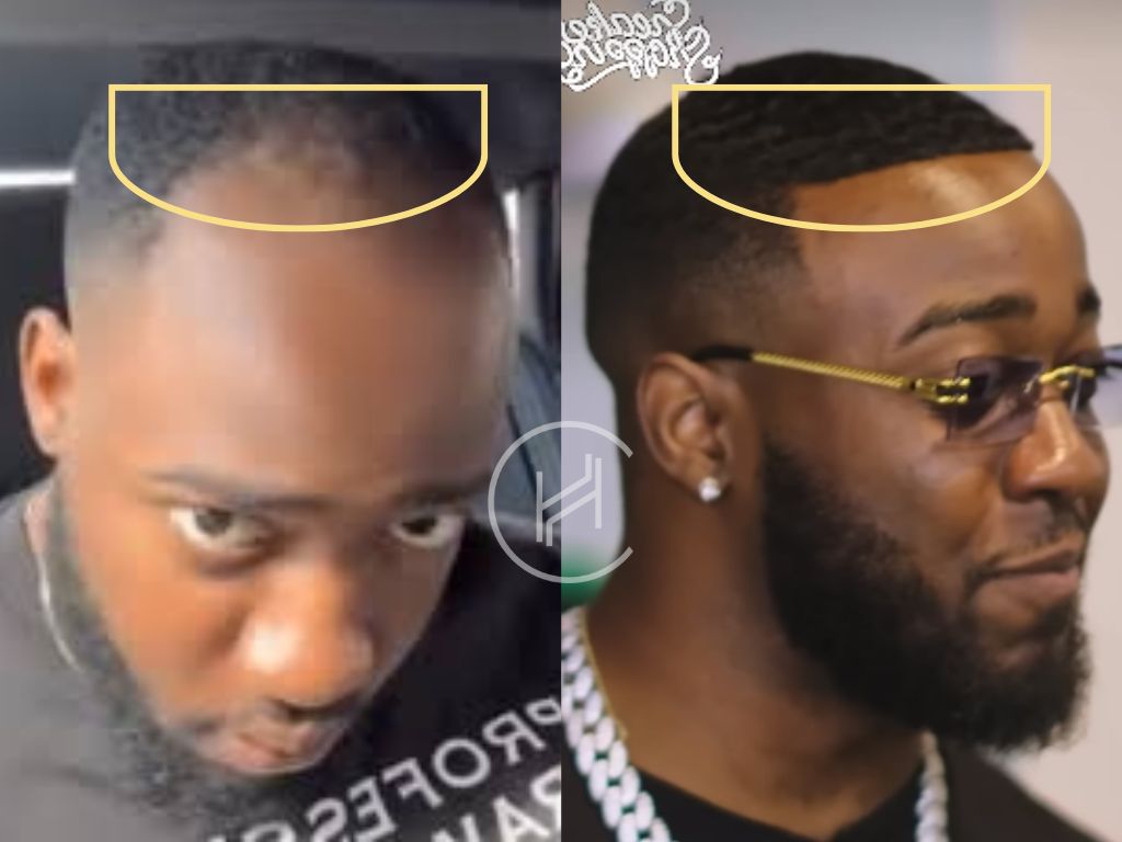 jidion - hair transplant before and after