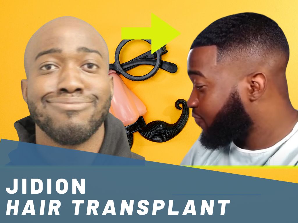 jidion hair transplant analysis banner
