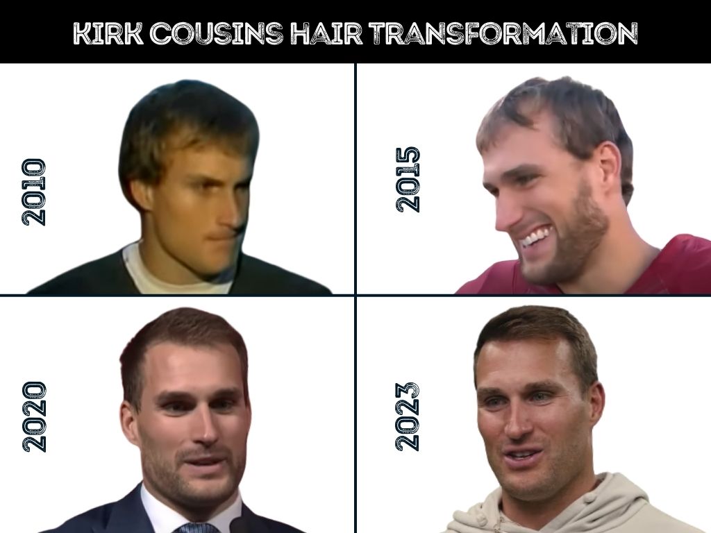 kirk cousins hair loss and transformation